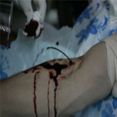 فصد درمانی