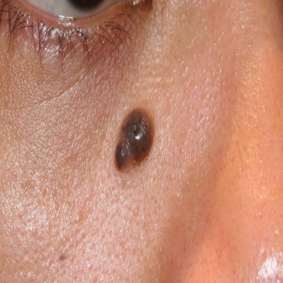 نکاتی مهم در مورد خال‌‌ها