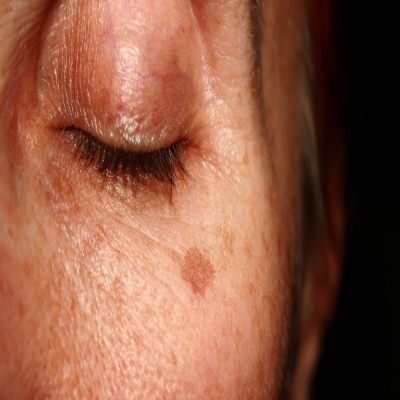 راهکارهایی برای کاهش لکه‌های پیری پوست